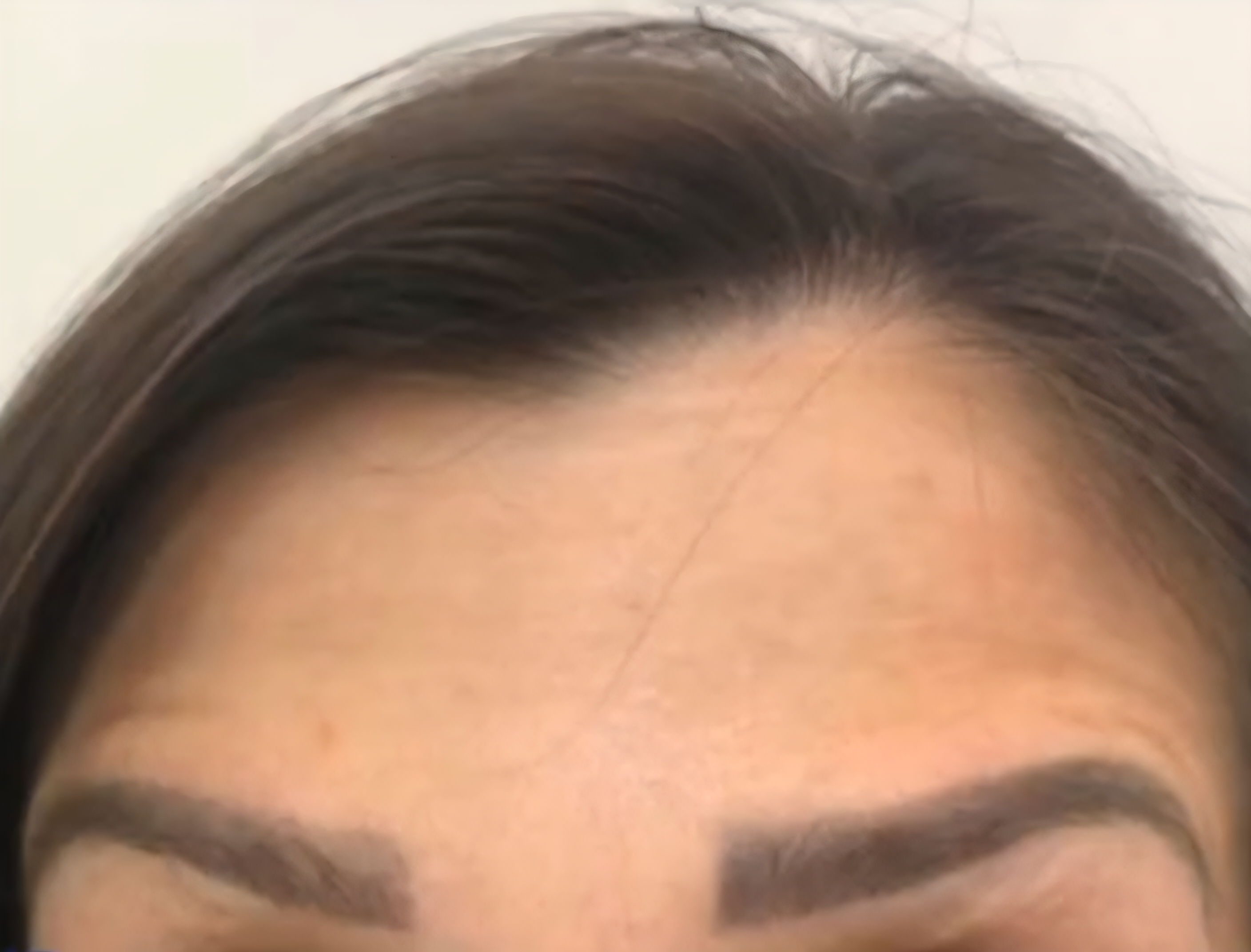 Depois do Botox